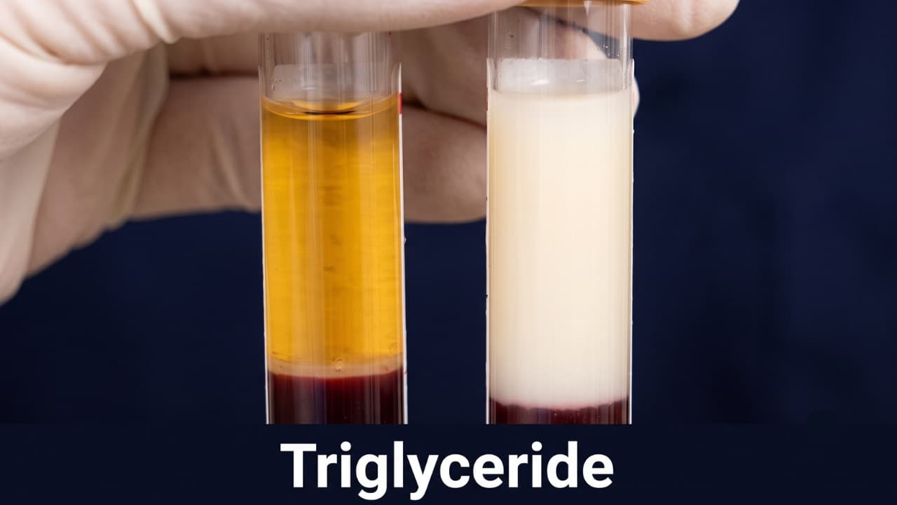 Triglyceride cao: Làm gì để giảm và mất bao lâu?